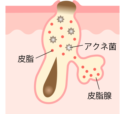 角栓が酸化して黒ニキビに