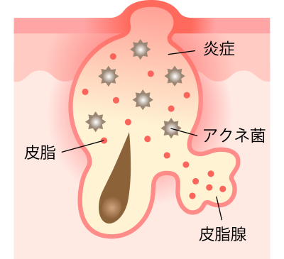 ニキビが悪化し炎症を起こして赤ニキビに