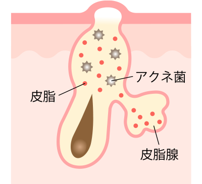 初期段階の白ニキビ