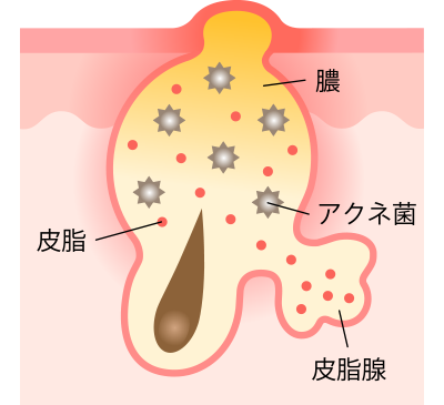 膿が溜まって最も悪化した状態である黄ニキビに